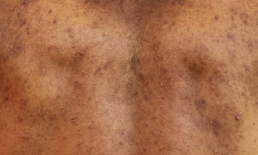 espalda acne corporal