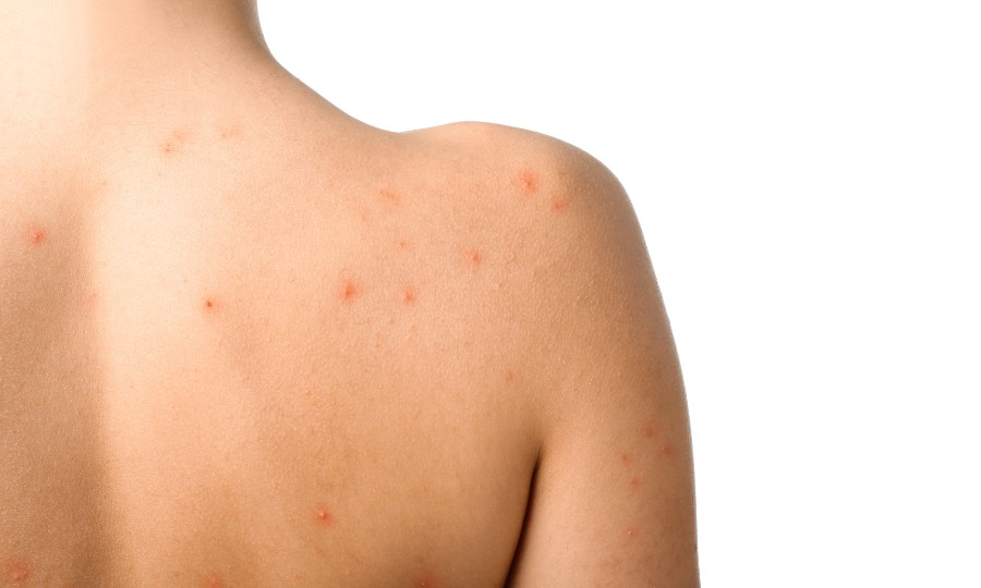 espalda acne corporal