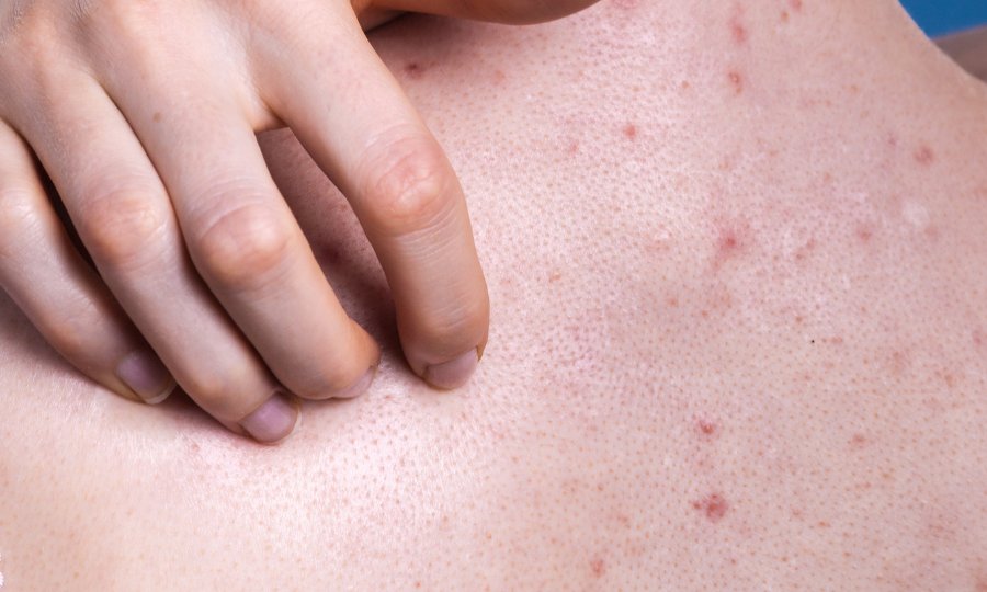 espalda acne corporal