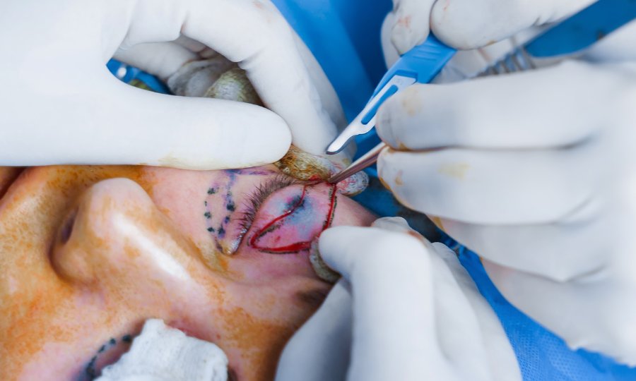 levantar parpados caidos blefaroplastia seguro