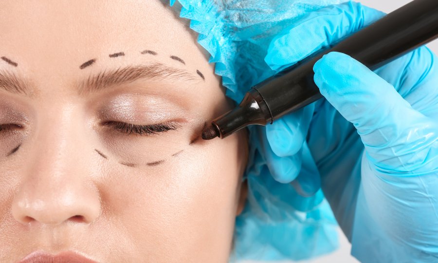 levantar parpados caidos blefaroplastia