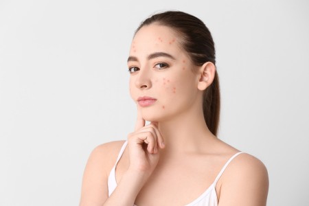 por que acne no desaparece