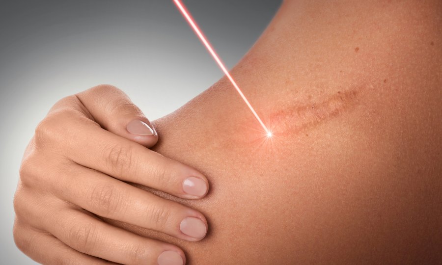 queloides laser tratamiento