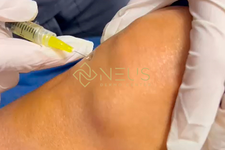 rodilla infiltracion