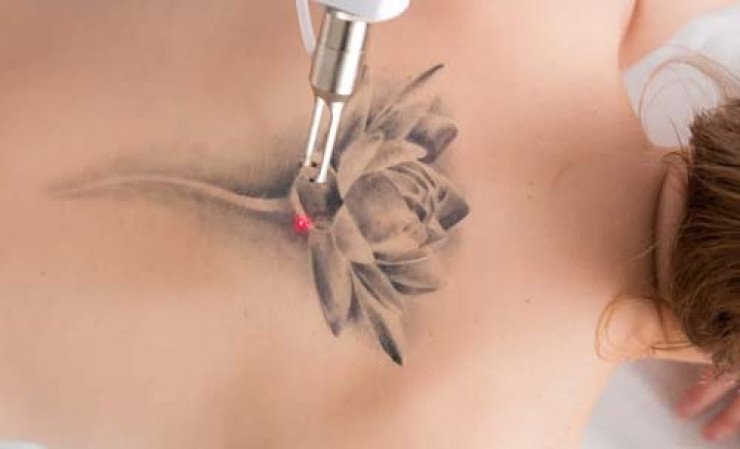 Tattoo Removal o Remoción de Tatuajes