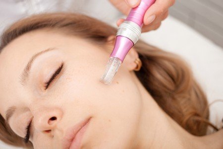 tratamientos profesionales acne