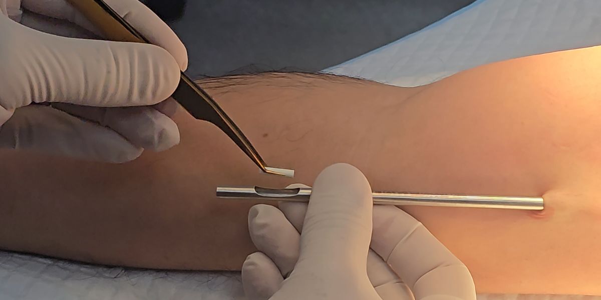 Pellets hormonal de testosterona en Ecuador - ¿Qué es el chip de la potencia?