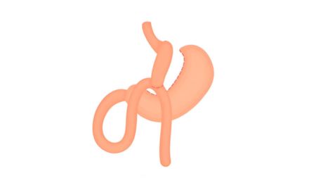 como se hace un bypass gastrico