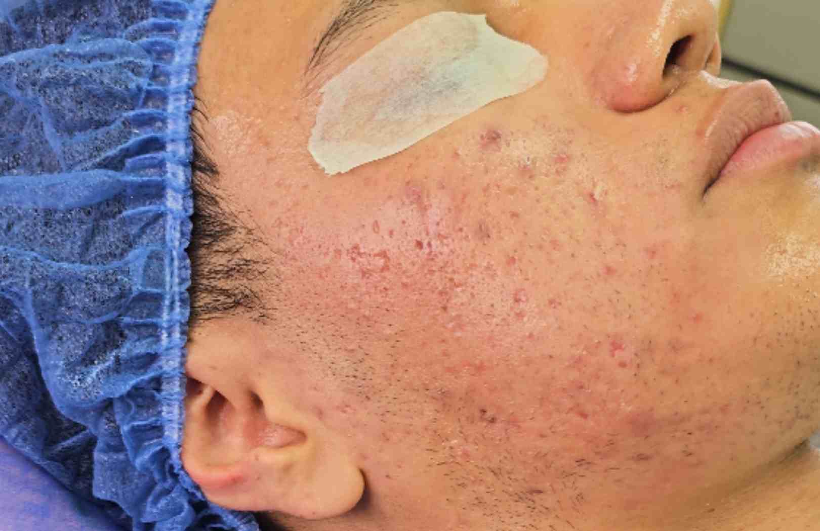 Acido Salicílico para el acné - ¿Realmente sirve?
