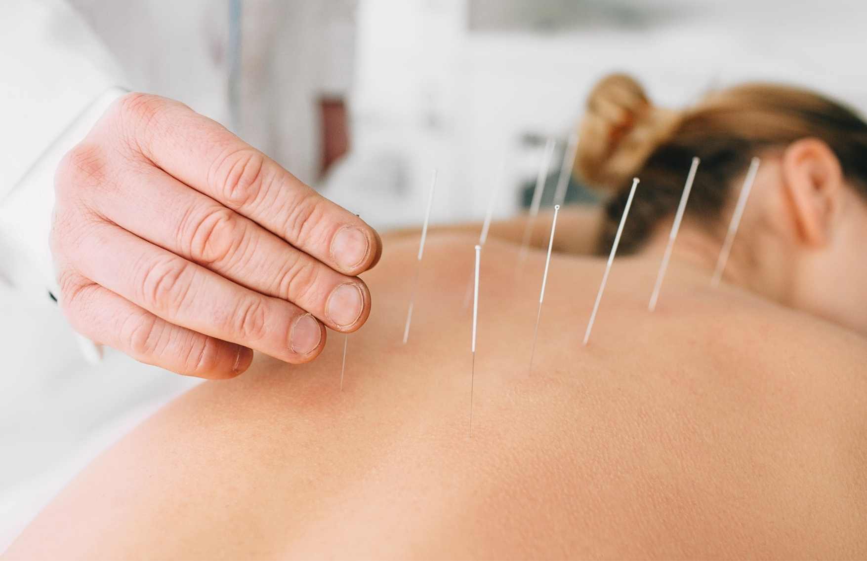 ¿Qué es la acupuntura? - Medicina Tradicional China 
