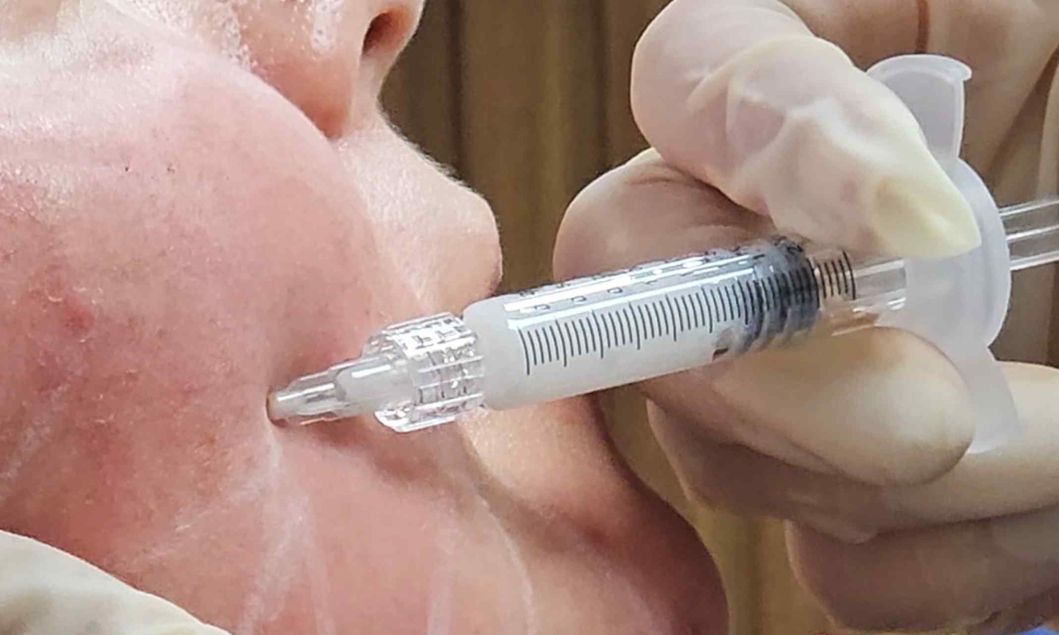 Bioestimuladores de colágeno en Quito - ¿Qué son?