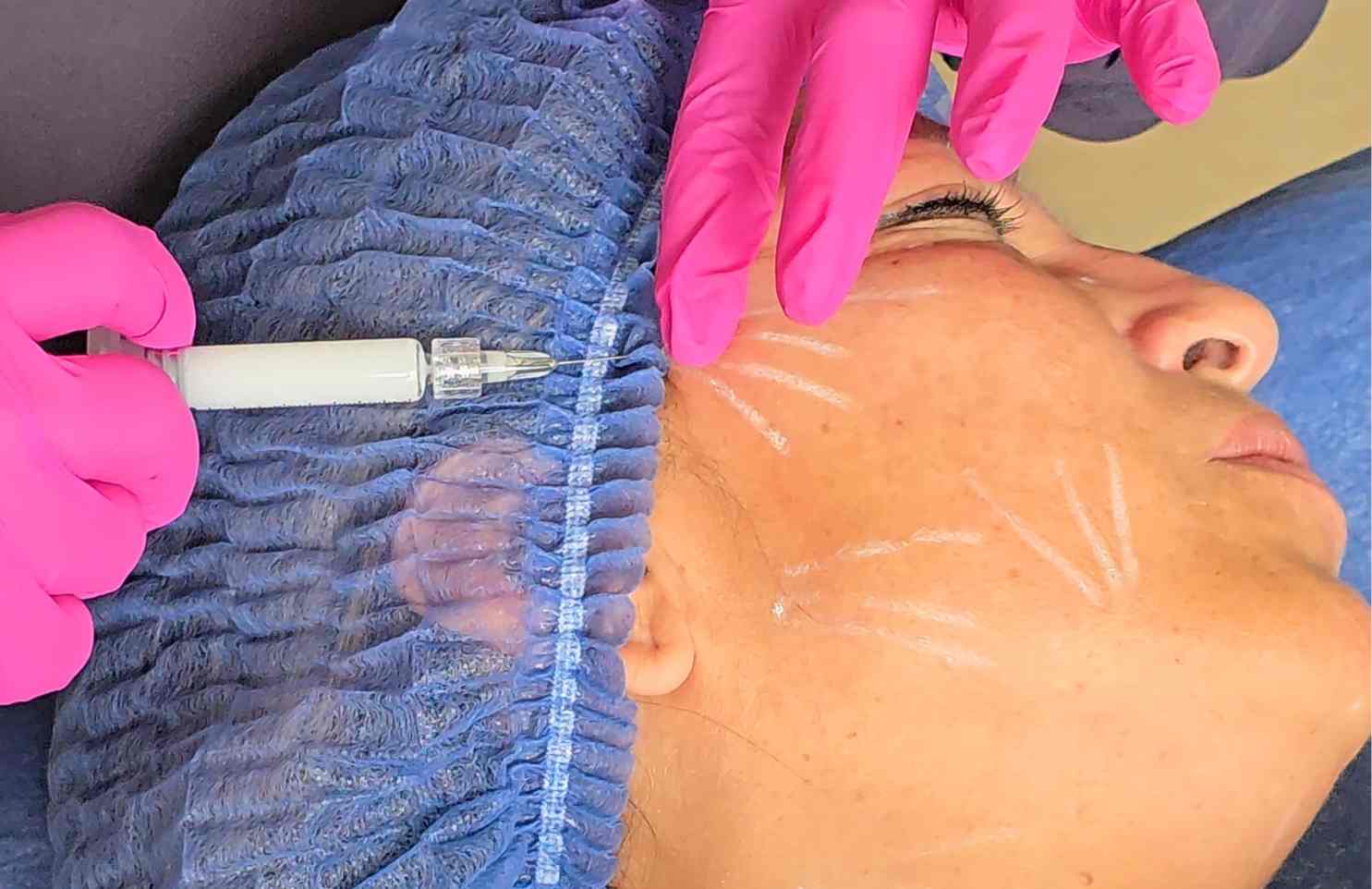 Bioestimuladores de colágeno - ¿Qué son y para que sirven?