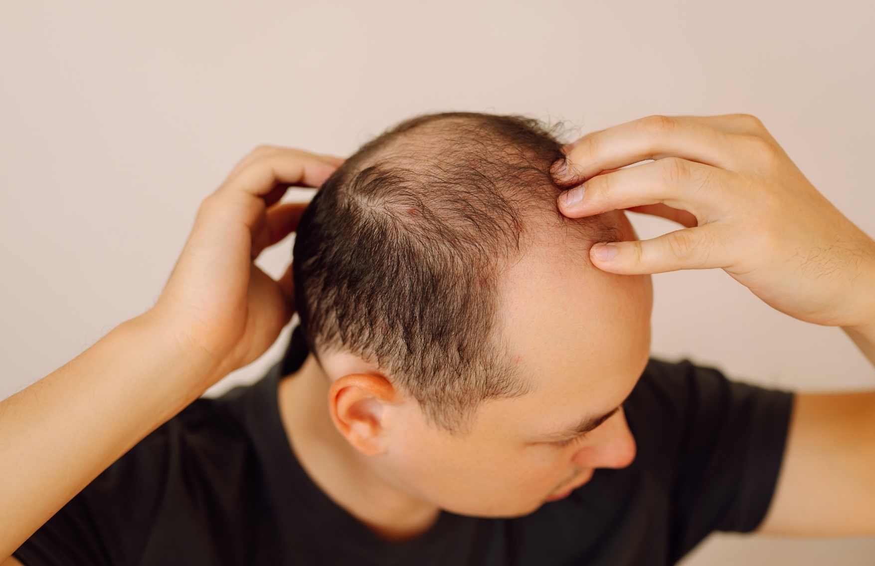 Tratamiento capilar - ¿Por qué se cae el cabello?