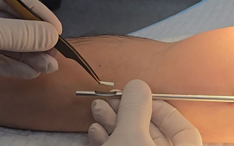 Pellets hormonal de testosterona en Ecuador - ¿Qué es el chip de la potencia?