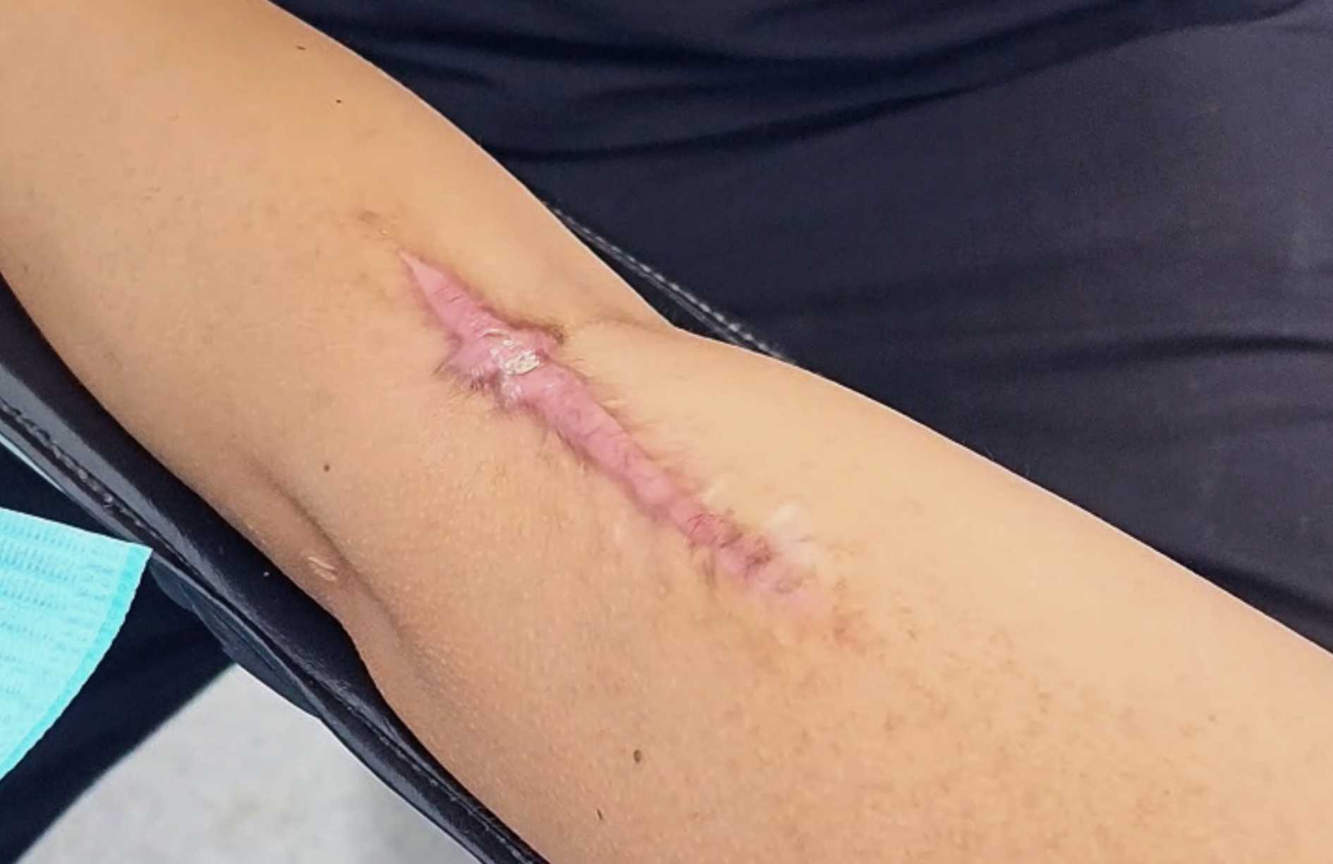 ¿Qué hacer si tienes cicatrices queloides? - Tratamiento para eliminar cicatrices