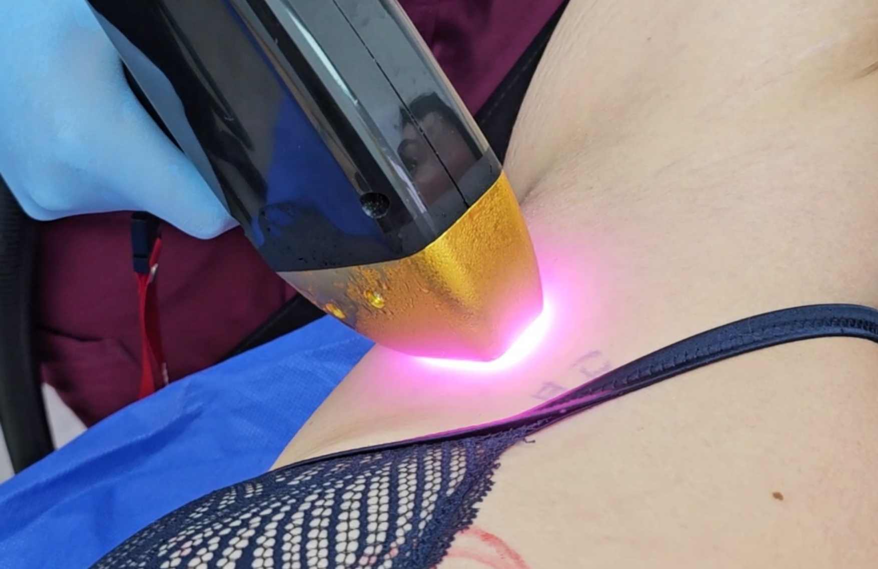 Depilación láser - ¿Qué tan recomendable es depilarse con láser diodo?