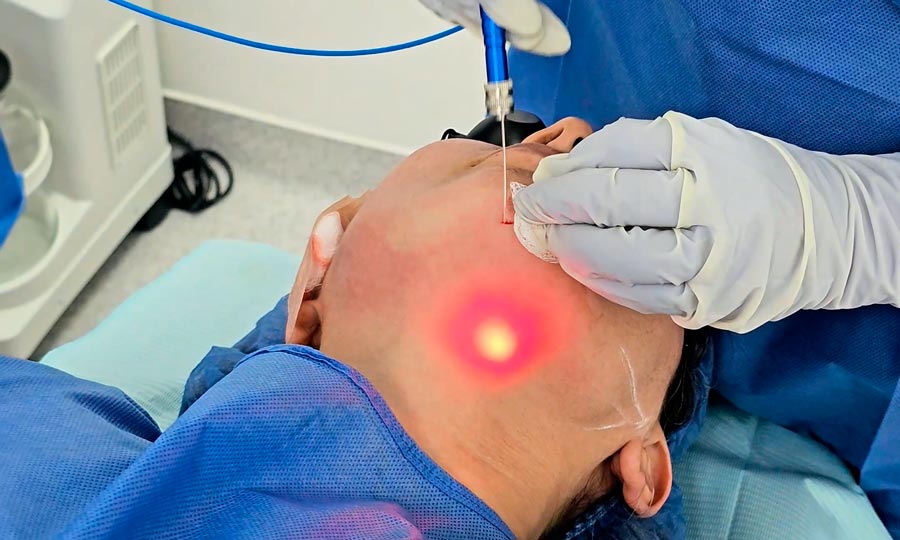 Antes y después del Endolift en Quito, un lifting sin cirugía