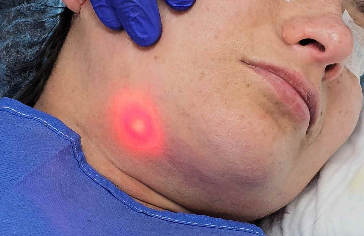 Endolifting facial - El láser que elimina la papada 
