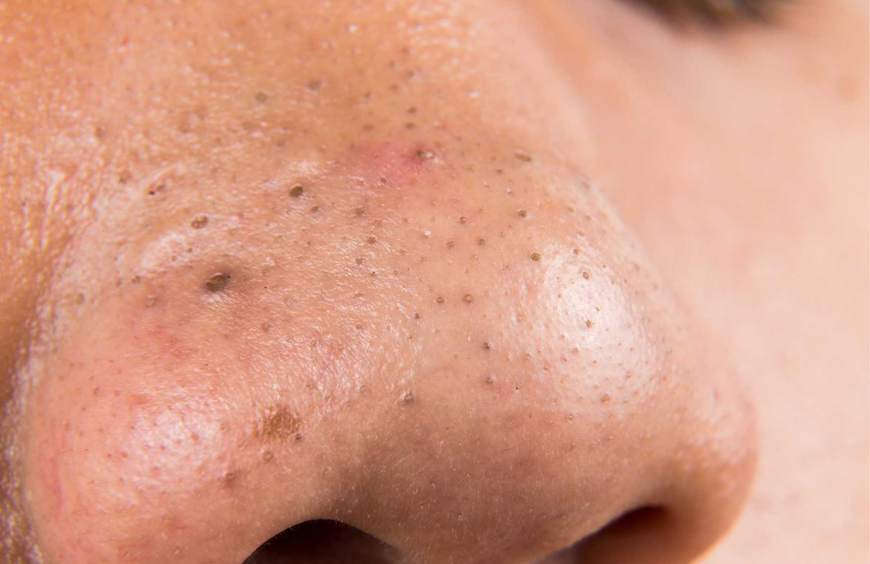 &iquest;Espinillas en la cara? - Remedios caseros para las espinillas