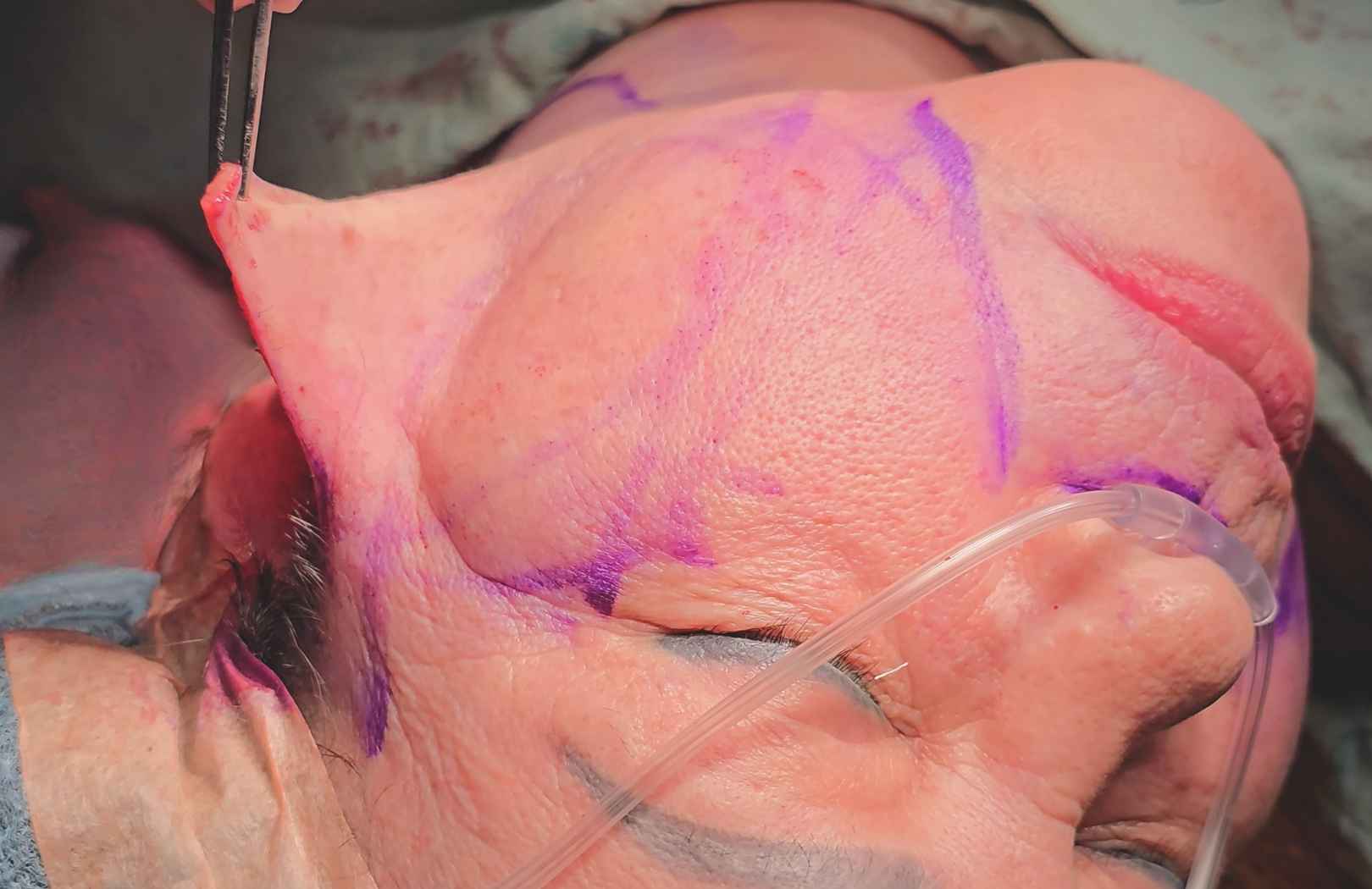 ¿Qué es el lifting facial?