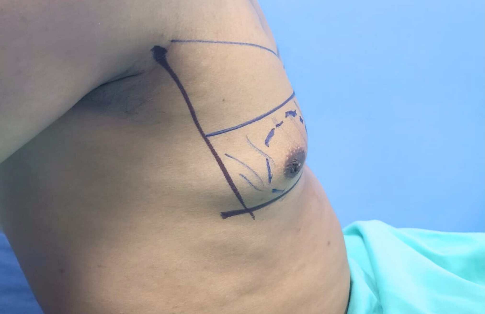 Ginecomastia - Eliminar grasa pectoral en hombres