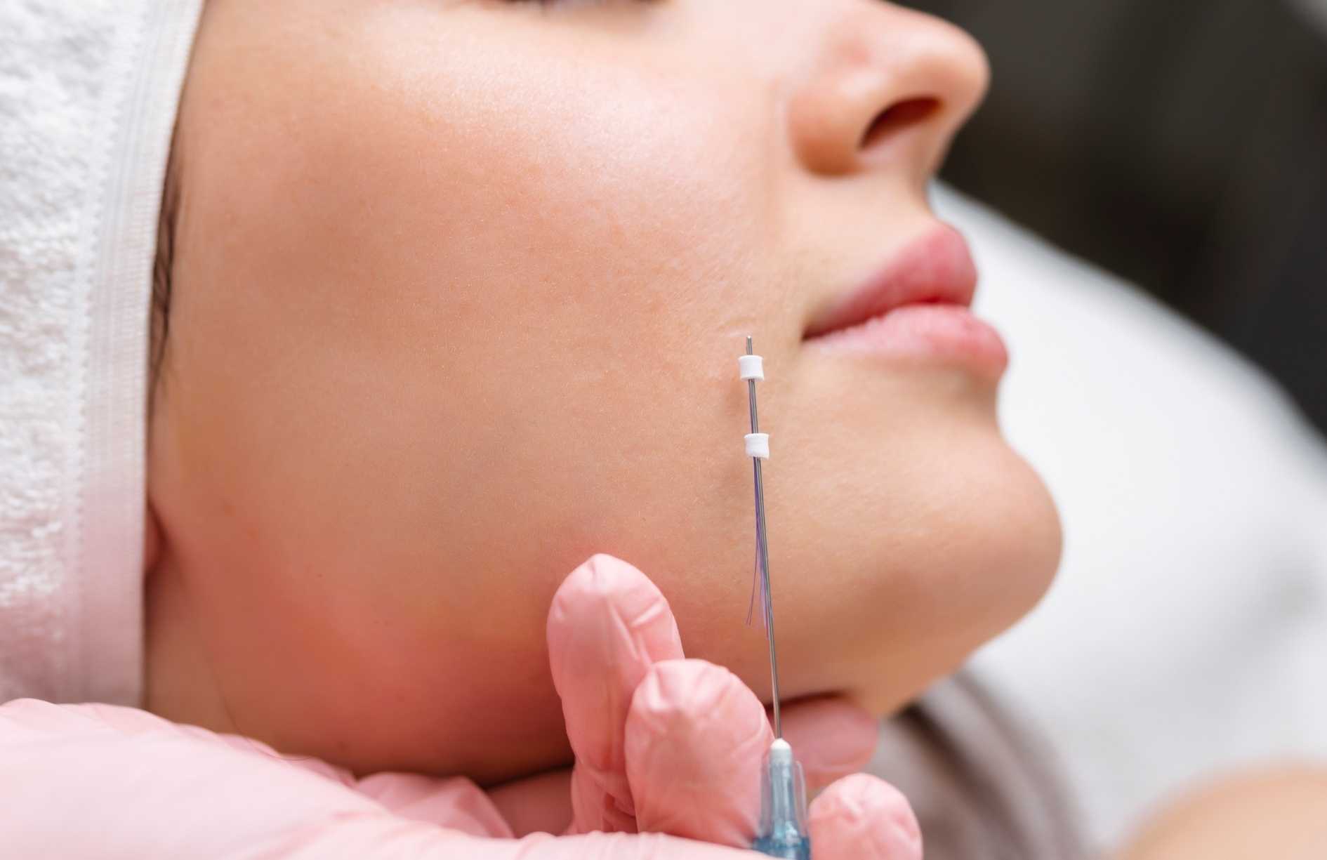 Hilos tensores para la cara - Lifting facial sin cirug&iacute;a 