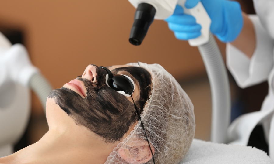 Hollywood peeling - ¿Carbón activado?
