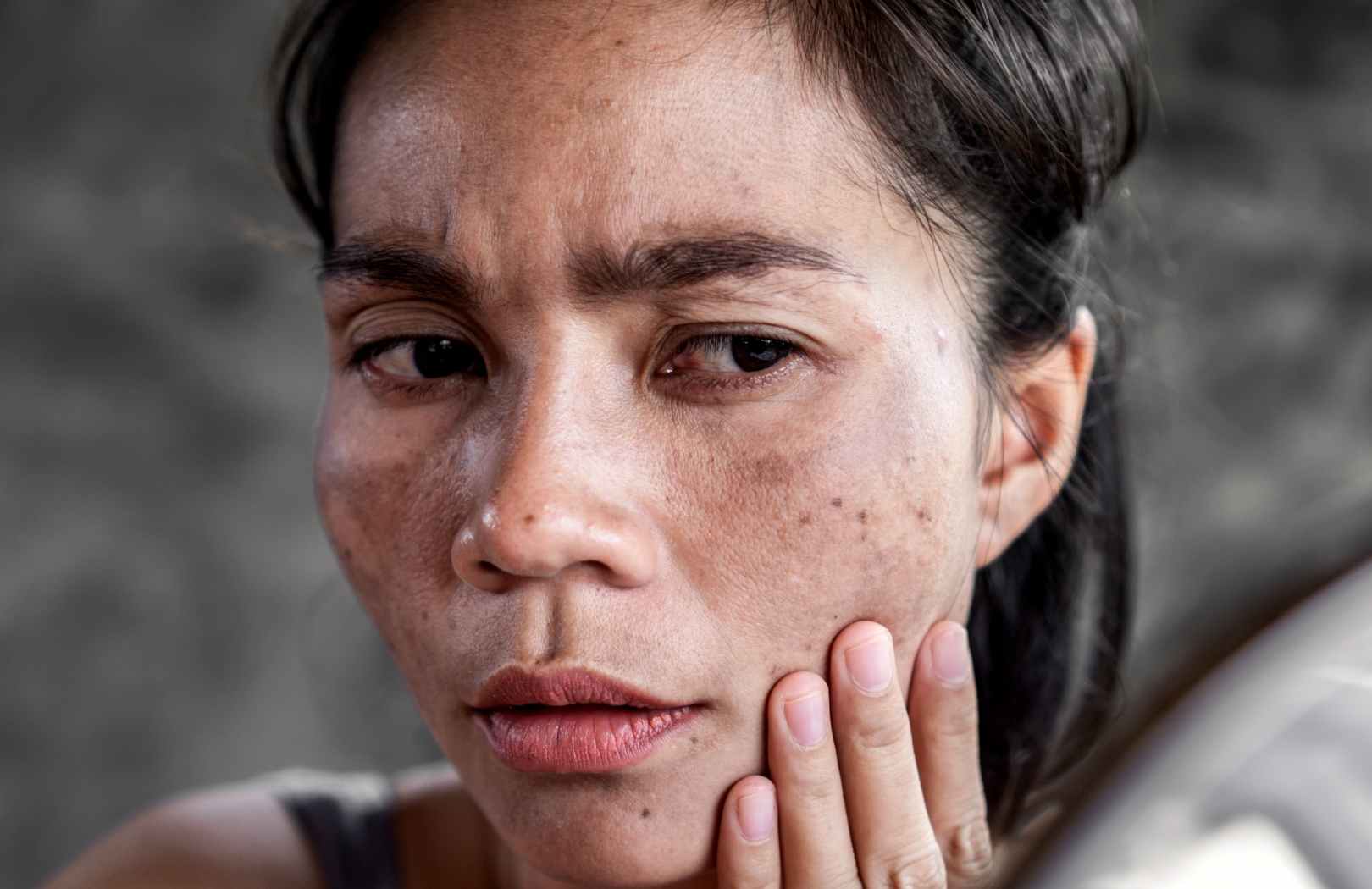 ¿Qué es el melasma? - Tratamiento para las manchas en la cara