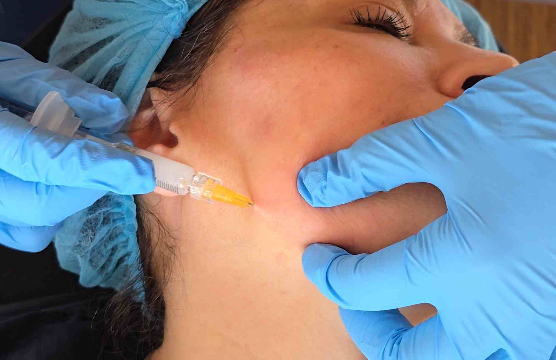 Radiesse en Quito: Bioestimuladores para rejuvenecimiento facial