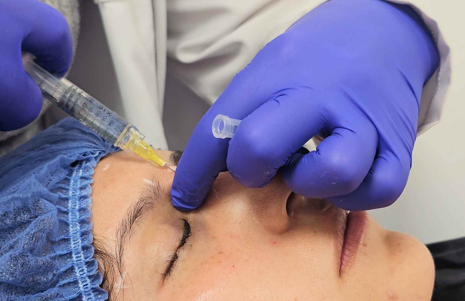 Rinomodelación con acido hialurónico - ¿Cuánto dura en la nariz? 